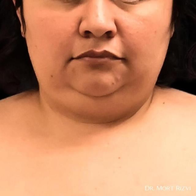Neck Liposuction before at West Empire Plastic Surgery in Los Angeles, CA