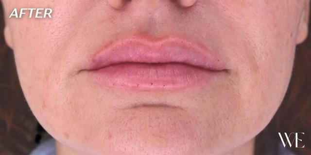 Lip Filler after at West Empire Plastic Surgery in Los Angeles, CA