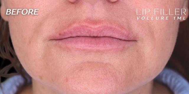 Lip Filler before at West Empire Plastic Surgery in Los Angeles, CA