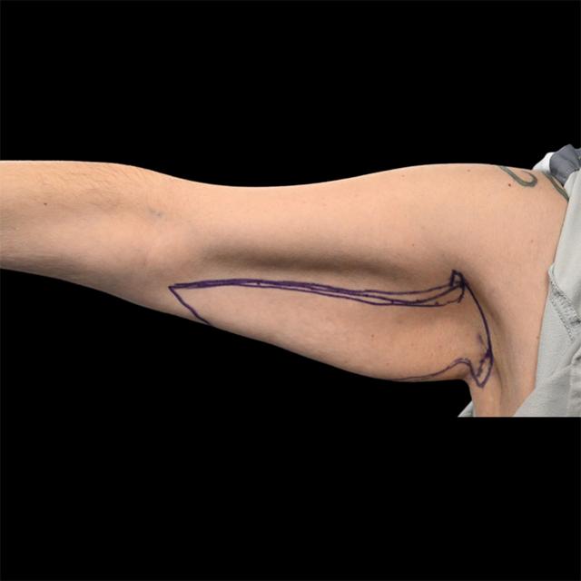 Arm Lift before at West Empire Plastic Surgery in Los Angeles, CA