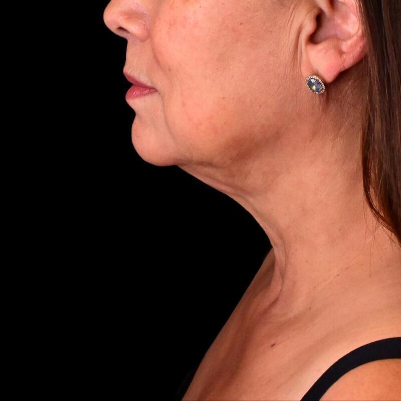 West Empire Plastic Surgery submental liposuction after — Glendale, CA