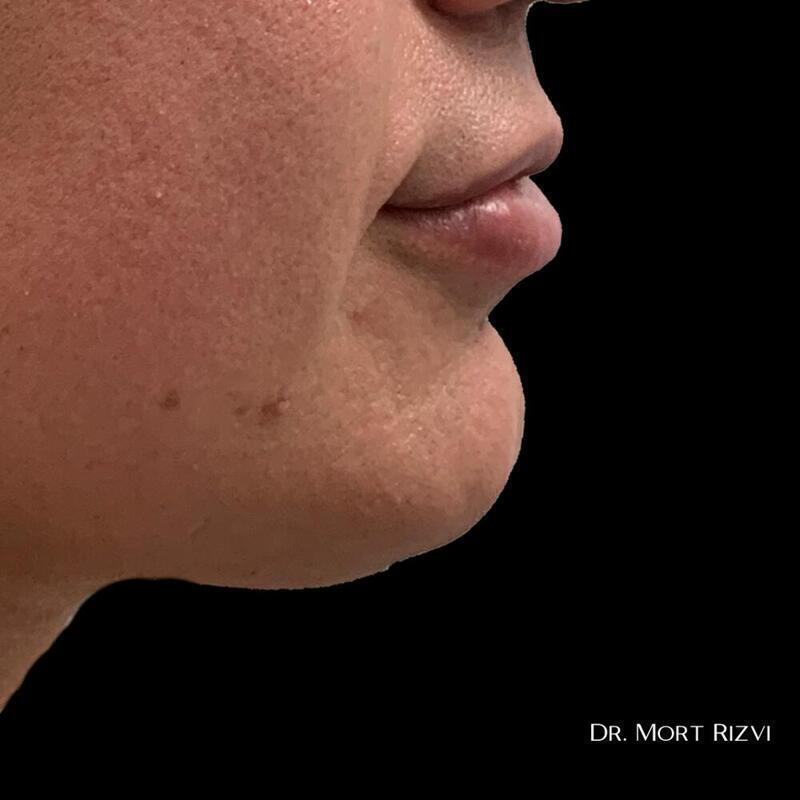 West Empire Plastic Surgery chin implant after — Glendale, CA