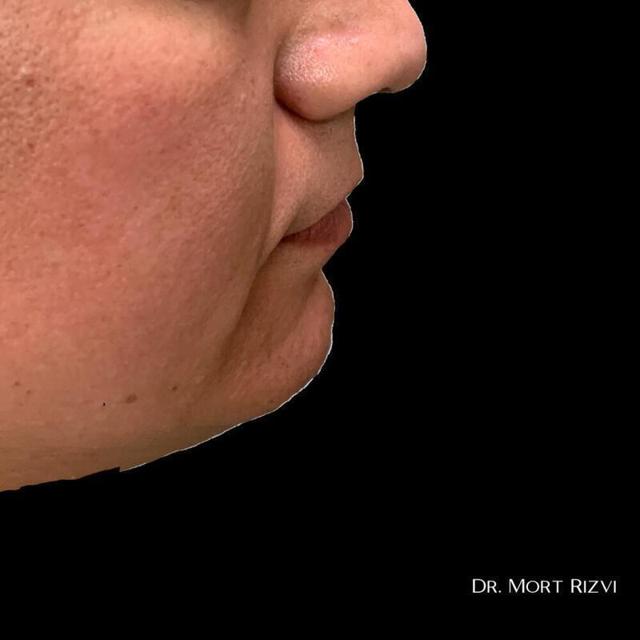Chin Implant before at West Empire Plastic Surgery in Glendale, CA