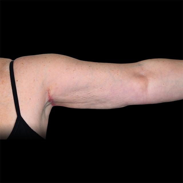 Arm Lift after at West Empire Plastic Surgery in Los Angeles, CA