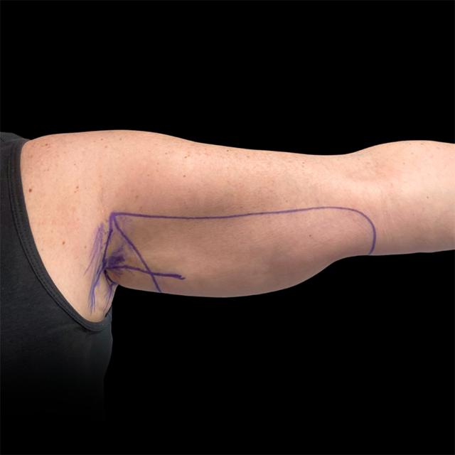 Arm Lift before at West Empire Plastic Surgery in Los Angeles, CA