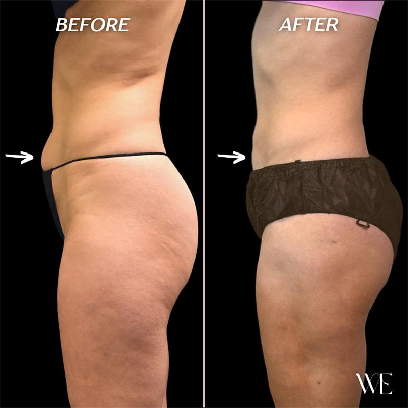 West Empire Plastic Surgery liposuction result — Los Angeles, CA