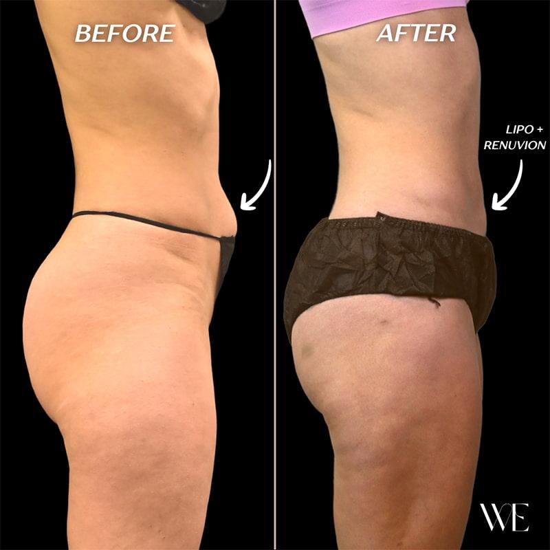 West Empire Plastic Surgery liposuction result — Los Angeles, CA