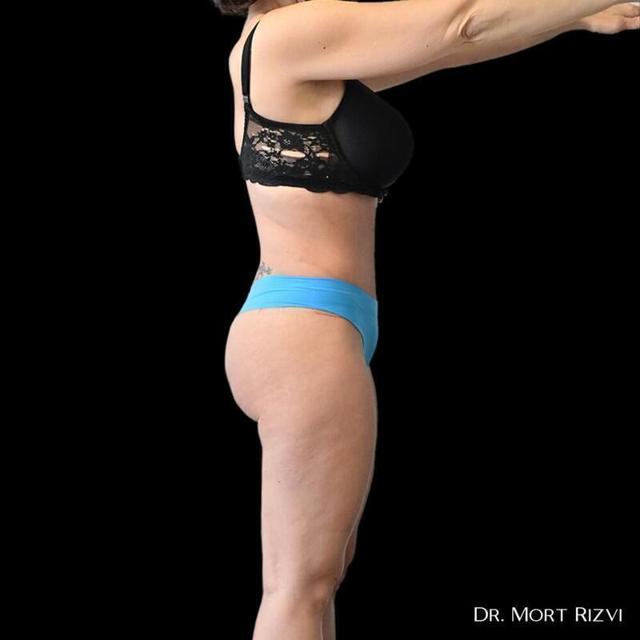 Tummy Tuck after at West Empire Plastic Surgery in Los Angeles, CA