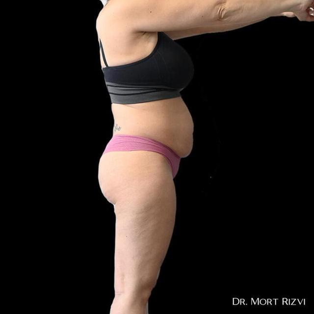 Tummy Tuck before at West Empire Plastic Surgery in Los Angeles, CA