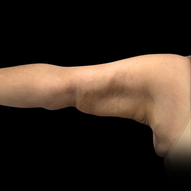 Arm Lift after at West Empire Plastic Surgery in Los Angeles, CA