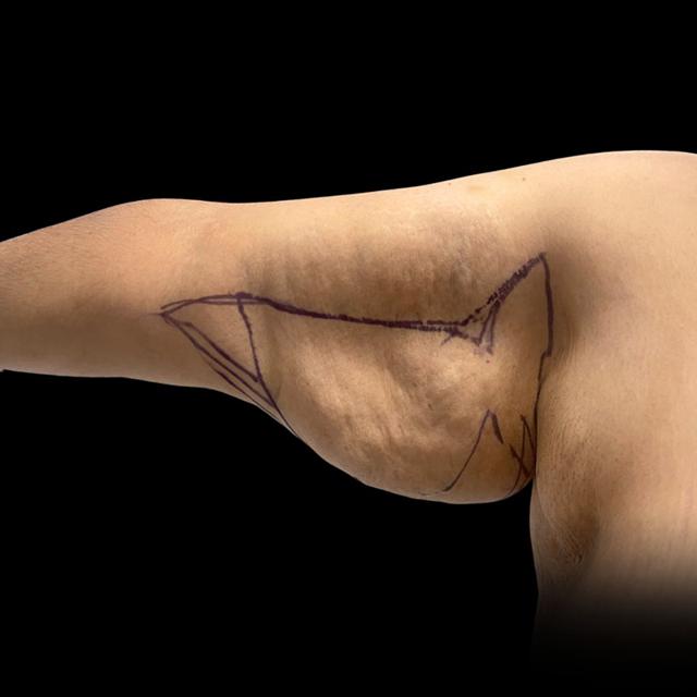 Arm Lift before at West Empire Plastic Surgery in Los Angeles, CA