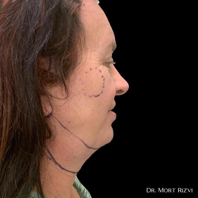 Deep Plane Facelift before at West Empire Plastic Surgery in Los Angeles, CA
