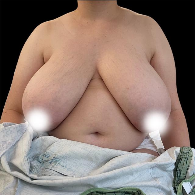 Breast Lift before at West Empire Plastic Surgery in Los Angeles, CA