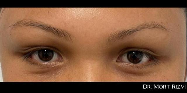 Brow Lift after at West Empire Plastic Surgery in Los Angeles, CA