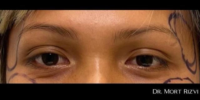 Brow Lift before at West Empire Plastic Surgery in Los Angeles, CA