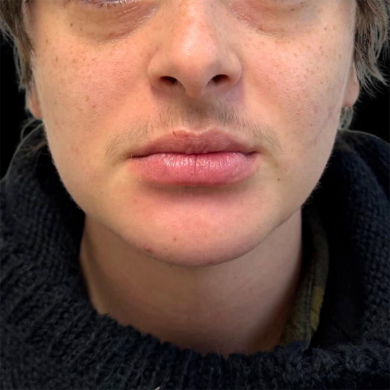 West Empire Plastic Surgery chin implant after — Glendale, CA