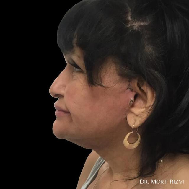 Deep Plane Facelift after at West Empire Plastic Surgery in Los Angeles, CA