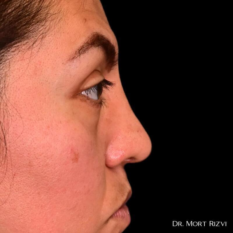 West Empire Plastic Surgery rhinoplasty after — Glendale, CA