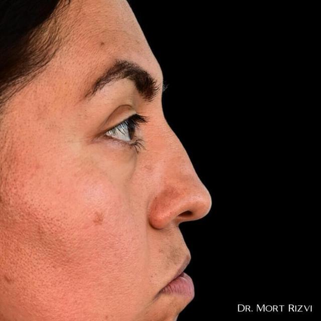 Functional Rhinoplasty before at West Empire Plastic Surgery in Los Angeles, CA