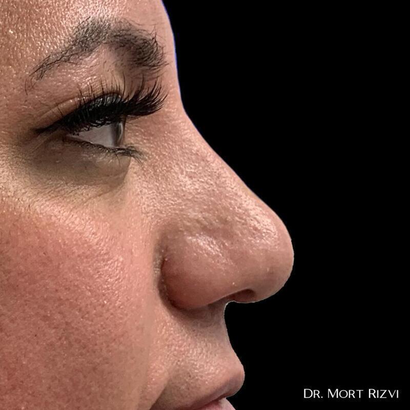West Empire Plastic Surgery rhinoplasty after — Glendale, CA