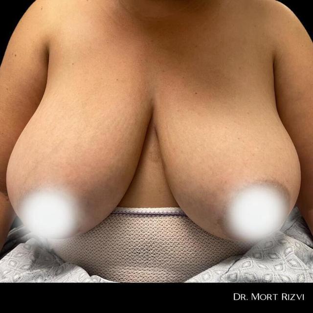 Breast Reduction before at West Empire Plastic Surgery in Los Angeles, CA