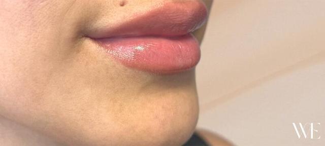Lip Filler after at West Empire Plastic Surgery in Los Angeles, CA