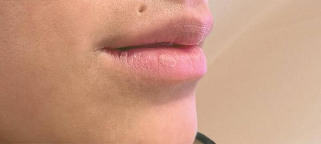 Lip Filler before at West Empire Plastic Surgery in Los Angeles, CA