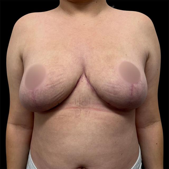 Breast Lift after at West Empire Plastic Surgery in Los Angeles, CA