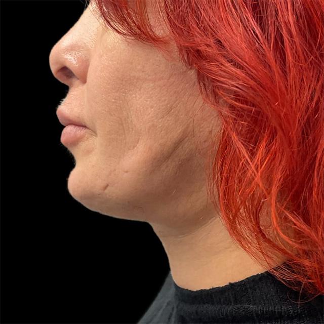 Neck Lift after at West Empire Plastic Surgery in Los Angeles, CA