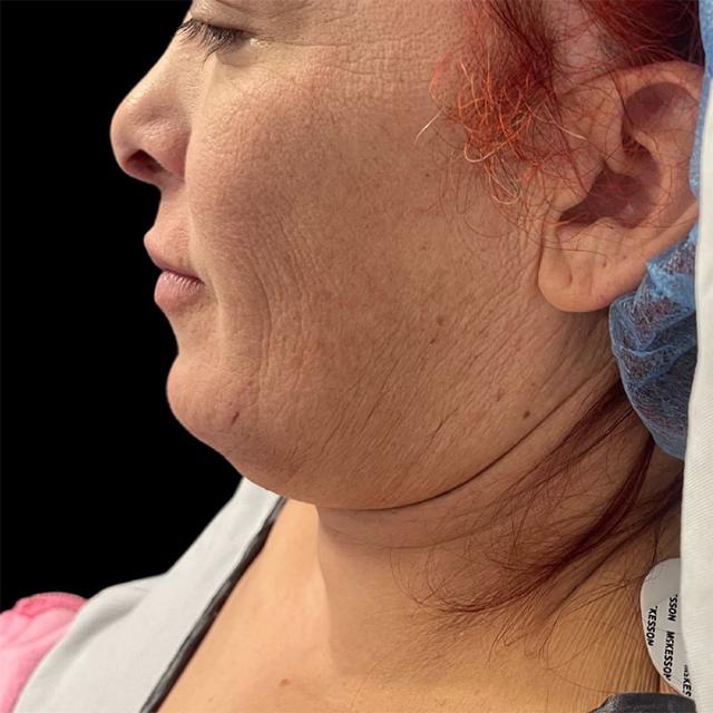 Neck Lift before at West Empire Plastic Surgery in Los Angeles, CA