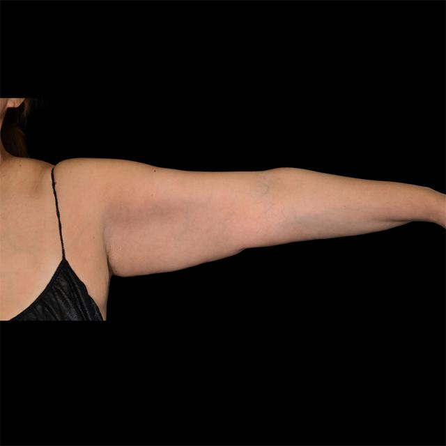 Arm Lift before at West Empire Plastic Surgery in Los Angeles, CA
