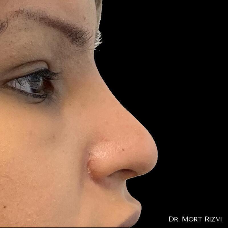 West Empire Plastic Surgery rhinoplasty after — Glendale, CA