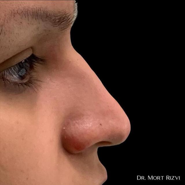Functional Rhinoplasty before at West Empire Plastic Surgery in Los Angeles, CA