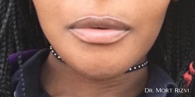 Chin Implant after at West Empire Plastic Surgery in Glendale, CA