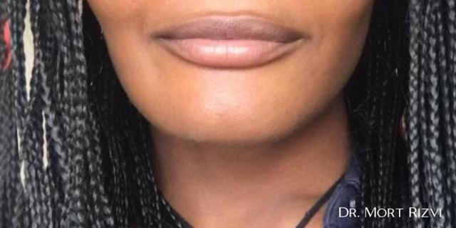 Chin Implant before at West Empire Plastic Surgery in Glendale, CA