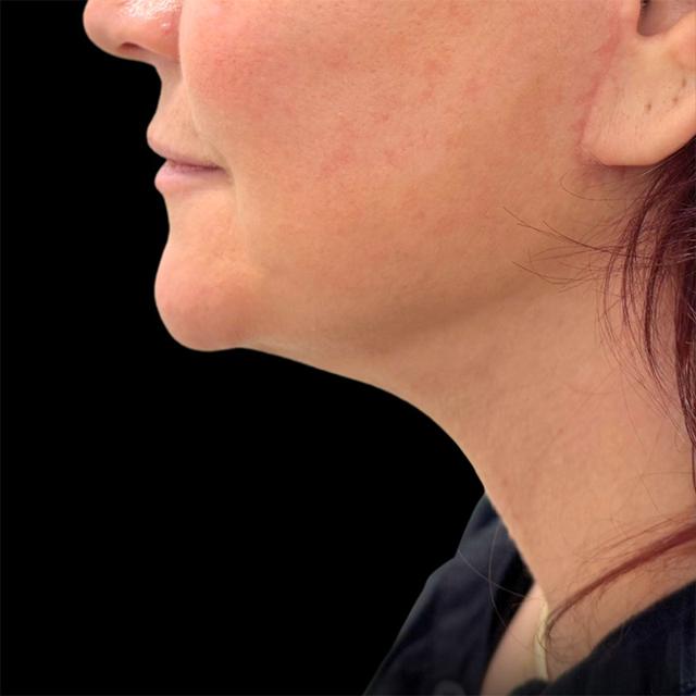 Neck Lift after at West Empire Plastic Surgery in Los Angeles, CA