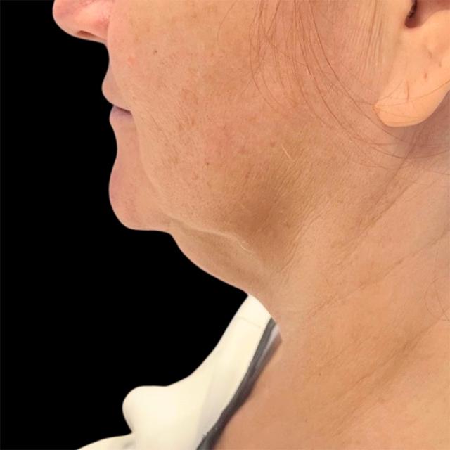 Neck Lift before at West Empire Plastic Surgery in Los Angeles, CA