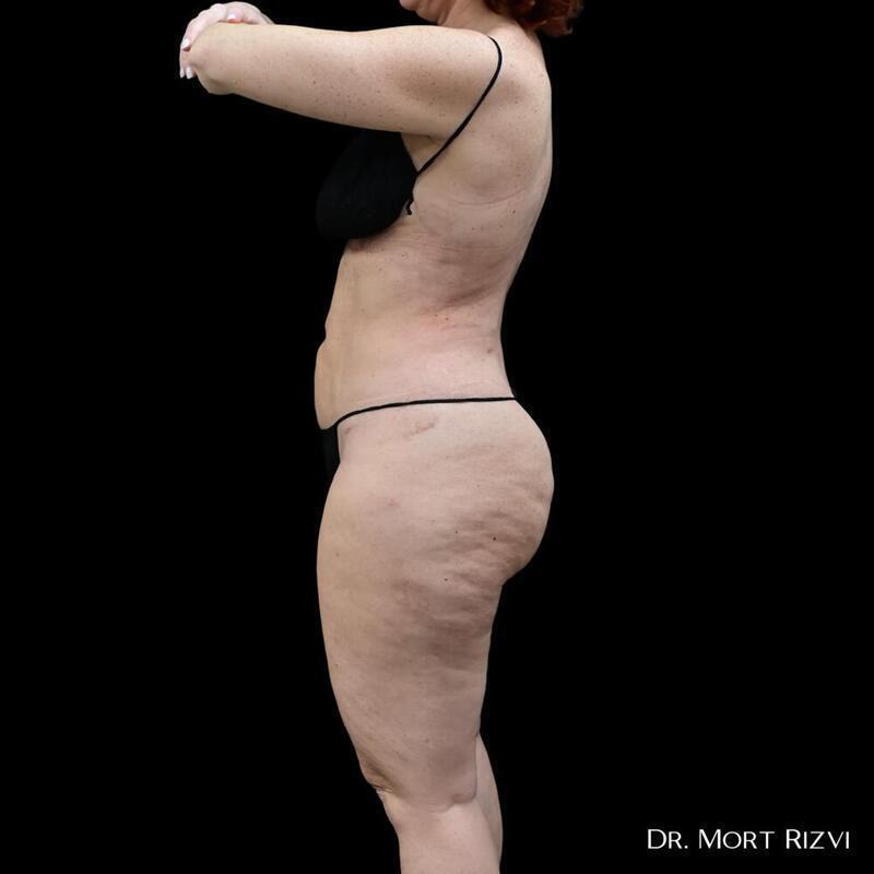 West Empire Plastic Surgery liposuction after — Los Angeles, CA