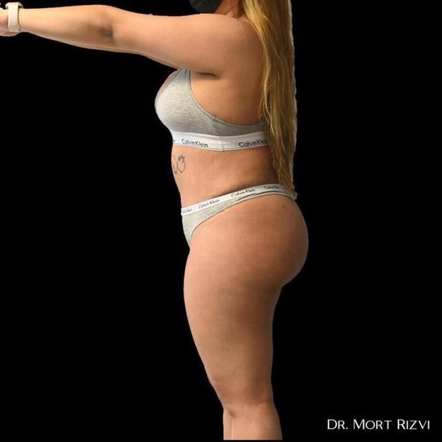 Brazilian Butt Lift after at West Empire Plastic Surgery in Los Angeles, CA