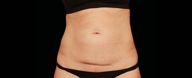 CoolSculpting after at Vitalyc Medspa | Highland Park in Dallas, TX