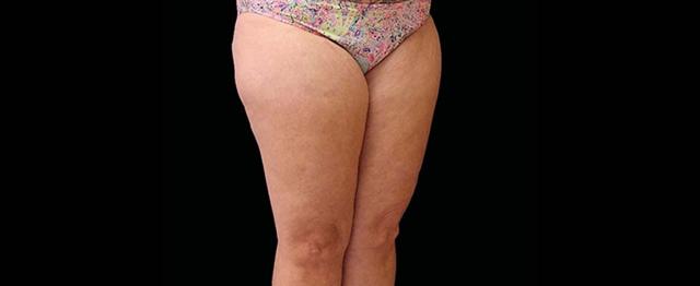 Thigh Lift after at Vitalyc Medspa | Highland Park in Dallas, TX