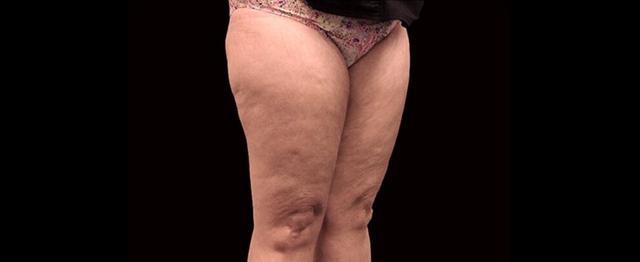 Thigh Lift before at Vitalyc Medspa | Highland Park in Dallas, TX