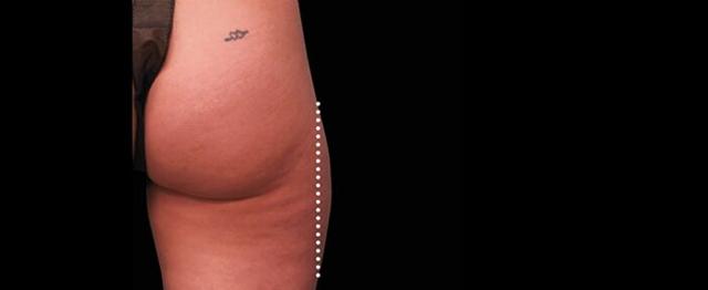Thigh Lift before at Vitalyc Medspa | Highland Park in Dallas, TX