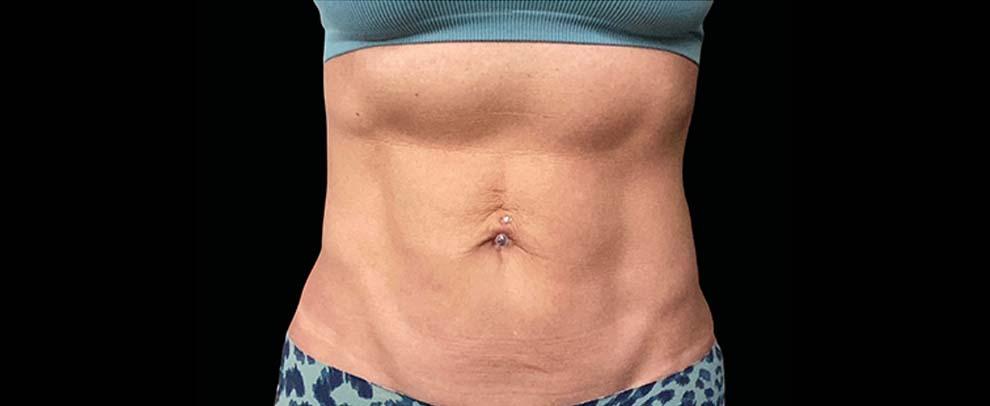Vitalyc Medspa | Highland Park body contouring after — Dallas, TX