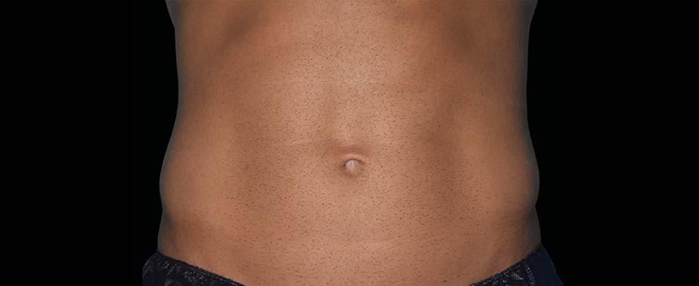 Vitalyc Medspa | Highland Park body contouring after — Dallas, TX