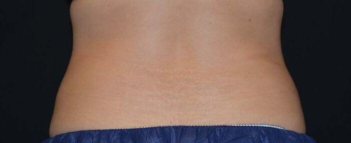 Vitalyc Medspa | Highland Park coolsculpting after — Dallas, TX
