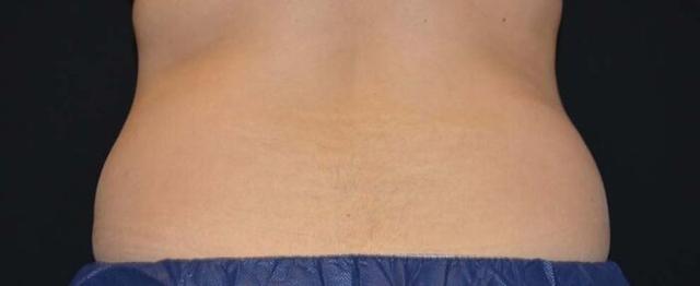 CoolSculpting before at Vitalyc Medspa | Highland Park in Dallas, TX