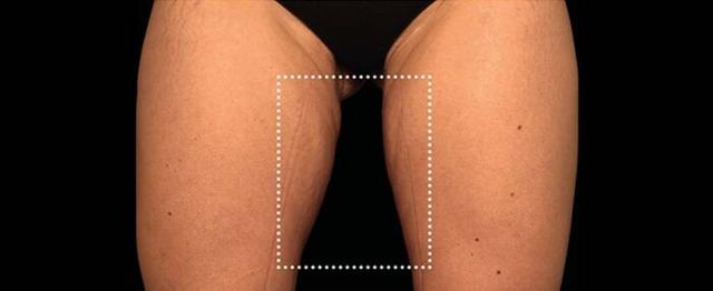 Thigh Lift after at Vitalyc Medspa | Highland Park in Dallas, TX