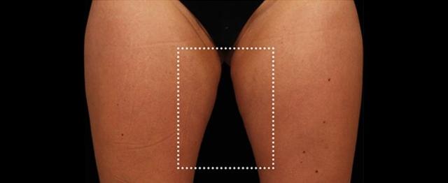 Thigh Lift before at Vitalyc Medspa | Highland Park in Dallas, TX