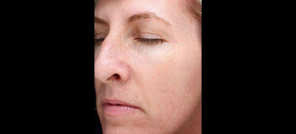 Vitalyc Medspa | Highland Park microneedling after — Dallas, TX
